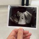 딩동멍 | [임신기록] 두 번째 계류유산, 소파술 후기 (10주, 심정지)