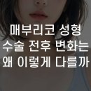 협진약품 | 매부리코 성형 수술 전후 변화는 왜 이렇게 다를까