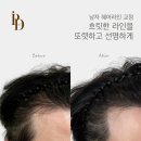 수헤어라인 이미지