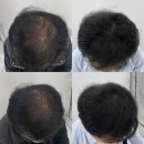 포항두피문신ㅣ정수리탈모 빼곡하게 가능한 곳