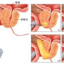 연세우리비뇨기과의원 네이버블로그