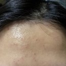 1편) 대전 월평동 굿닥터의원 후기, 편평사마귀 co2 레이저 후기