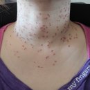 황비뇨기과의원 | 수원의 성지 쥐젖제거 광교피부과 미드림피부과