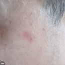 서울가정의학과의원 | 고양 덕양구 삼송 원흥 도래울 서울s가정의학과의원 검버섯 점 제거 피부과의원 추천 내돈내산