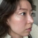 청담 프라이빗 피부과 :: 리프팅,피부결 관리 쥬베룩 효과,후기
