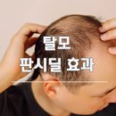 모두모의원 | 탈모 판시딜 주요 효과 및 후기 부작용 알아보기