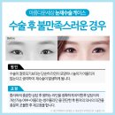 아름다운세상성형외과 / 눈재수술 / 강남눈전문병원 / 쌍수잘하는곳 / 쌍수유명한곳 / 쌍수후기 / 눈재수술전문 / 쌍수 / 이미지