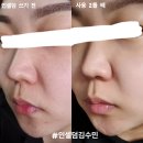 인셀덤신화 | 인셀덤 효과가 빠르고 더딘 사람들의 특징과 이유(+ 찐 리얼후기사진)