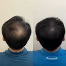 라니네세탁 | 광주 쌍촌동 두피문신 르니뷰티 : 두피문신 탈모커버 SMP ‘4회차 솔직후기’