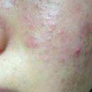 아시아약국 | 에스로반 연고 효능 약국 가격 여드름 관리 찐 후기