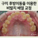 심한 덧니 비발치 후방이동 교정치료 후기, 전후 비교