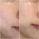 율하4로 접속부~율하1로 접속부 | LDM물방울리프팅 효과 김해 율하 피부관리 &#39;데이로제뷰티&#39; 후기