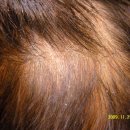Hair the kyun(헤어더균) | 약물 없이 해결한다! 겨울철 두피 통증과 비듬 잡는 원탈모클리닉