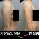 [네이버카페사진후기 By 난날씬님][허벅지/복부/팔]팔지방흡입전후사진 이미지