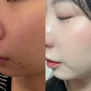 웰스피부과 | 웰스톡스 아쿠아프로 받고 온 후기 | 신용산역 앞 피부과에서 피부 컨디션 정리하고 옴