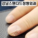 서울성모병원 사거리 성모병원 앞 교통섬 | 손톱위 발톱위 살이 자라나는 이유?강남스탠다드저형외과에서 알려드립니다.