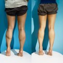 한스클리닉의원 | [수원 한스클리닉] 효과 좋은 영통 종아리보톡스 후기/전후비교사진/이벤트/비용