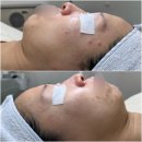 유일 | 청주 율량동 에스테틱 여드름압출 흉터 피부관리 5회 내돈내산 후기 | 유일에스테틱