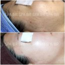 (임상사진 및 후기)여드름+아토피 피부
