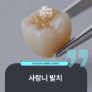 김앤김치과의원 | 사랑니 발치 꼭 해야 할까? 상황별로 정리해보기