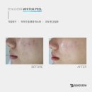 필링하우스 | 청라피부관리 화이톡스 솔직후기 [크리스티나하우스] 청라알라딘필링