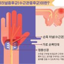 손목터널증후군이나 손목건초염이 있는지 간단하게 확인하는 방법.jpg 이미지