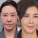 빅마마미용실 | '62세' 유혜리 안면거상+지방재배치 후 반응이 난리난 이유 "못 알아볼 정도"