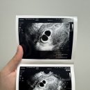 맑은샘약국 | [유월이&amp;오월이 일기] 10주차 계류유산_고사난자 판정 / 분당제일여성병원 소파술 후기