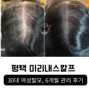 이혜정헤어라인 - 사천시 | 30대 여성 탈모 집중 관리 6개월 후기 | 가르마가 달라졌어요(실제 사진 있음)