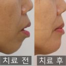 제이미성형외과의원 | 돌출입 교정 후기. 치아교정 후 사진 비교