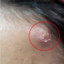 안제의원 | 피지낭종 제거수술 후기
