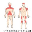 담 걸리는 이유, 근막통증 증후군 (뒷목 뻐근, 어깨뭉침, 가슴담 목담, 연관통) 이미지