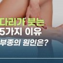 다리 부종 원인 다리 붓기 원인 다리 부기 원인 다리가 붓는 이유 다리 붓기 빼는 방법 이미지