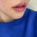 미소미 | 내돈내산 자연스럽게 예뻐지는 영등포피부과 미소미의원 입술 필러 입꼬리 보톡스 멍 붓기 후기