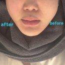 구월동 오라클피부과의원 | 인천 구월동 피부과 올타이트리프팅 600샷 리얼후기(+가격,통증)