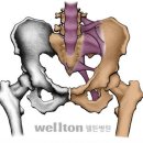 고관절인공관절 재수술시기는 언제 ?? [ 고관절인공관절 재치환술 :: 고관절인공관절 기구 수명 ] 이미지