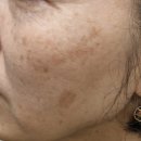 봄빛한의원 | 부산 흑자제거 양정 봄빛 한의원(현 봄한의원) 솔직 후기