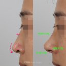 마귀할멈 이벤트 | 화살코수술로 마귀할멈코 사라졌어요!꿈꾸던 모습으로 개선(강남성형외과 +찝힌코)