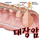 대장암 증상 '변비 해소법' 이미지