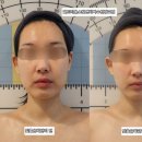 경기도 수원시 영통구 도청로89번길 | 광교에스테틱영통피부관리 엘트리움스킨앤바디 수원광교점 v파워윤곽관리 얼굴리프팅 후기