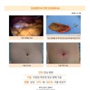 담낭용종수술후기. 수술통증도 금방 사라졌고, 배를 뚫는 수술을 했는데 다음날 퇴원할 수 있다는게 놀라울 따름입니다. 이미지