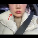 제주도 “서울 뉴라인의원” 온다 리프팅 탄력 심부볼 이중턱 개선 연예인리프팅
