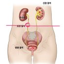 멘파워비뇨기과 | 신장(요관)결석 걸린 ssul (1)