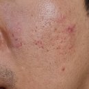 새살약국 | 여드름흉터 새살침 시술로 원인 타파 후기