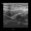 Lt inguinal hernia. 이미지