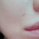 하태원성형외과의원 | [내돈내산] 함희정하태원성형외과 점 뺀 흉터제거 +12일차+42일차+76일 차+150일차+1년차 후기까지