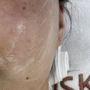 메디시스템 | 광주 수완지구 여드름 에스테틱 365메디스킨 플라즈마 솔직후기