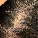 브로우난 | (파주 문산 두피문신 :브로우난 )SMP 유독 두피에 흉터가 많으신 분들만 찾는 샵?