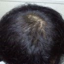 모생한의원 | 모생한의원 /탈모치료 후기 ( 권 0조님 )