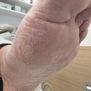 루덴풋케어닥터아이티엔 | 송파 잠실 발각질 말끔히 관리 받기 루덴풋케어
